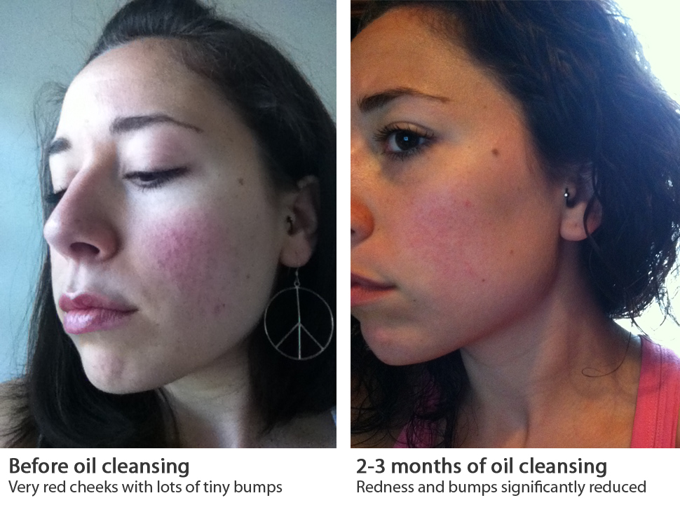 3 Day Apple Diet Results Acne Rosacea